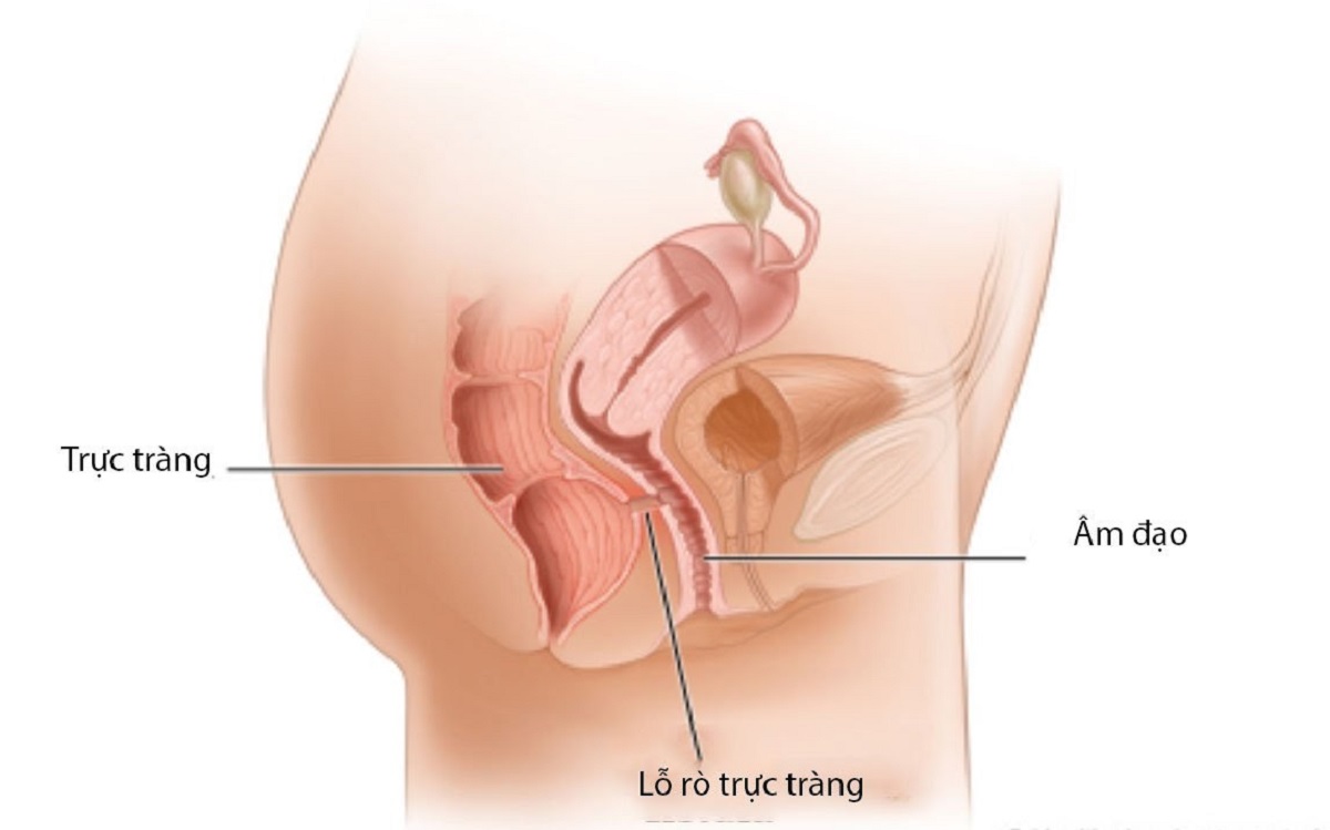 Nguyên nhân, triệu chứng và cách chẩn đoán lỗ rò âm đạo trực tràng