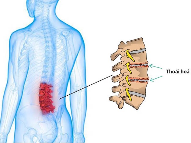 Nguyên nhân, triệu chứng và cách điều trị thoái hóa cột sống lưng