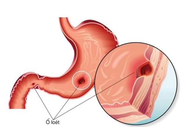 Nguyên nhân, triệu chứng và cách phòng ngừa viêm loét dạ dày