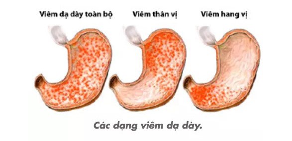 Nguyên nhân, triệu chứng viêm sung huyết hang vị dạ dày