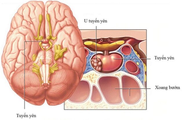 Nguyên nhân u tuyến yên đau đầu