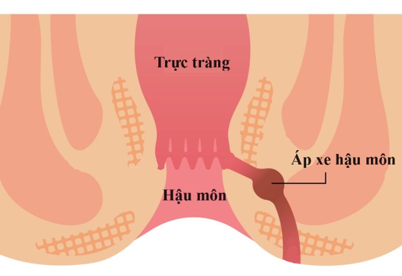 Nguyên nhân và biểu hiện của áp xe hậu môn, cách điều trị