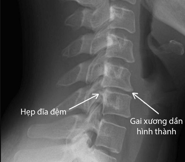 Nguyên nhân và biểu hiện đau vai gáy do thoái hóa cột sống cổ