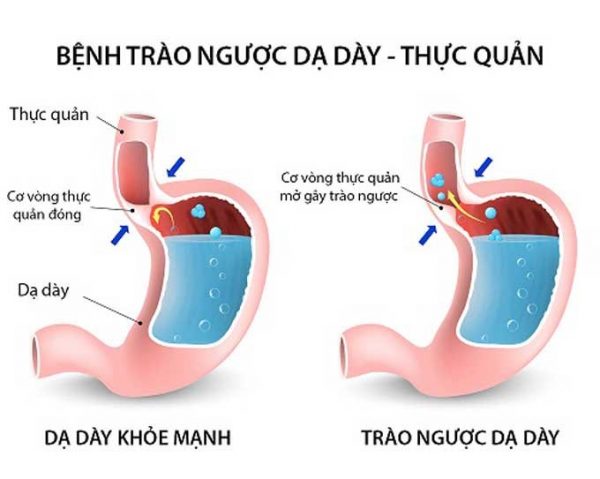 Nguyên nhân và biểu hiện trào ngược dạ dày thực quản