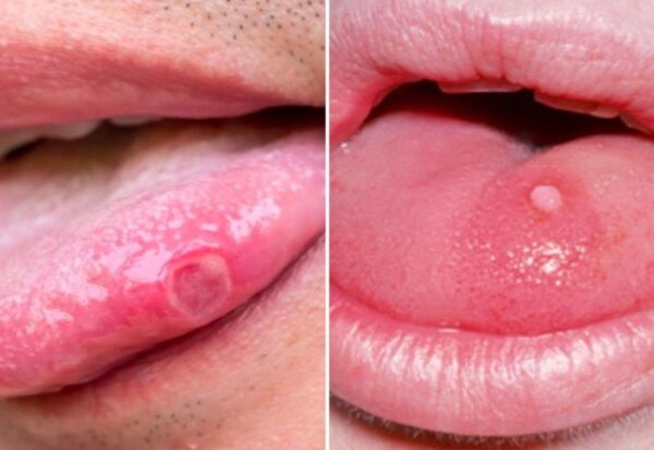 Nguyên nhân và cách chữa bệnh herpes ở lưỡi