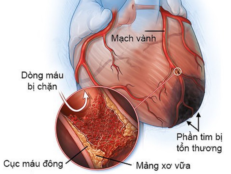 Nguyên nhân và cách điều trị bệnh tim mạch vành