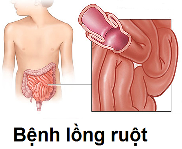 Nguyên nhân và cách điều trị hiệu quả khi bé bị lồng ruột