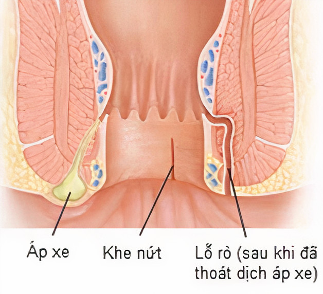 Nguyên nhân và cách điều trị rò hậu môn phức tạp