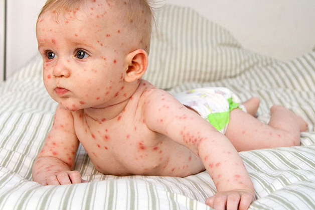 Nguyên nhân và cách điều trị sốt virus ở trẻ em hiệu quả