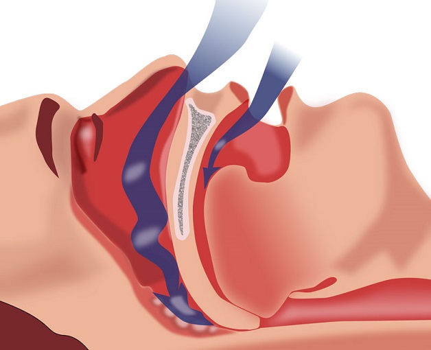 Nguyên nhân và cách điều trị tăng huyết áp kháng trị