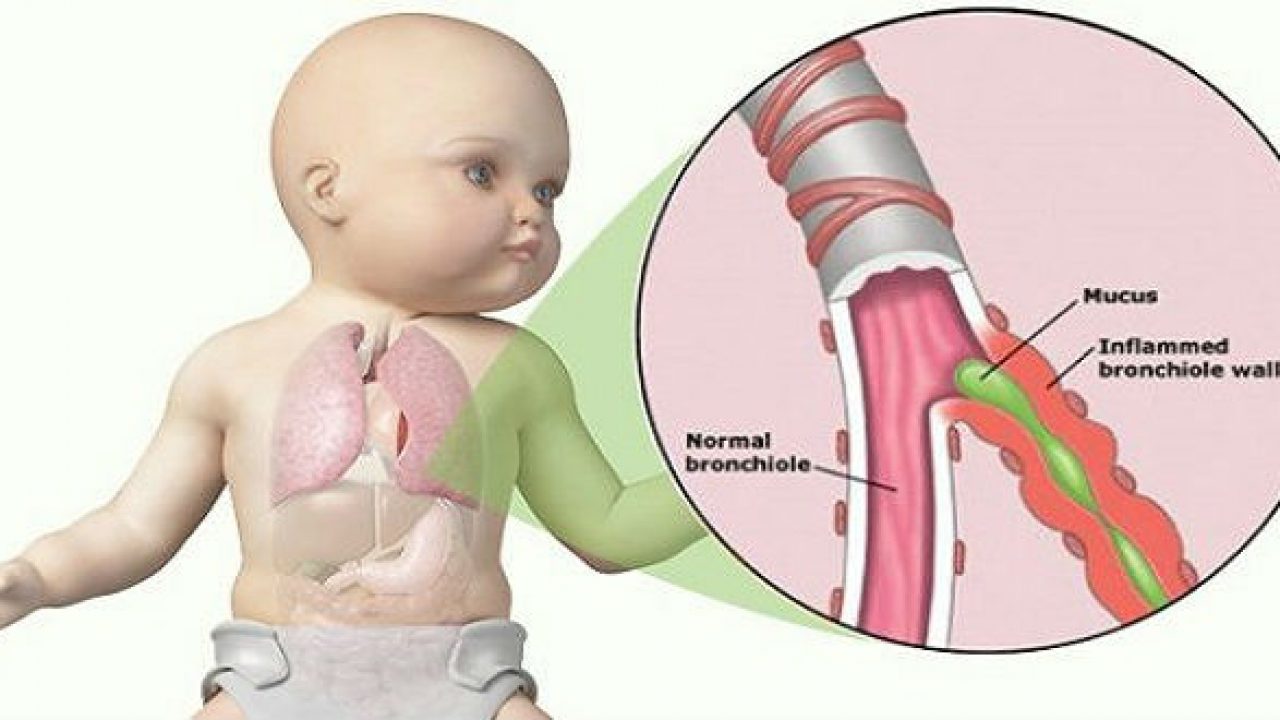 Nguyên nhân và cách điều trị viêm tiểu phế quản cấp ở trẻ