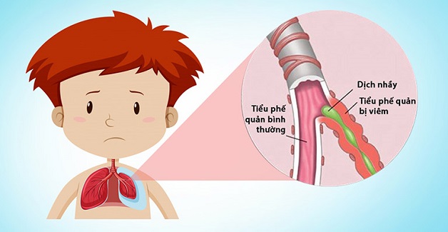 Nguyên nhân và cách điều trị viêm tiểu phế quản cấp ở trẻ