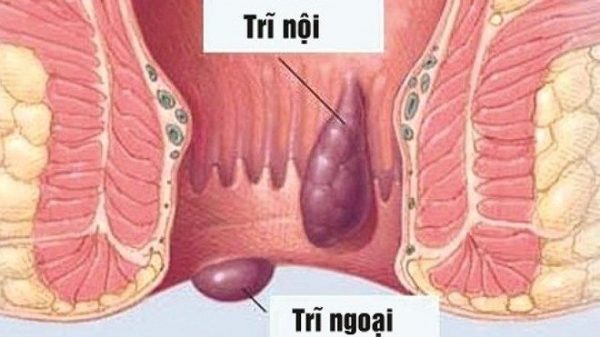 Nguyên nhân và cách phòng ngừa bệnh trĩ