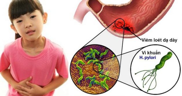 Nguyên nhân và cách phòng ngừa hiệu quả khi bé bị đau dạ dày