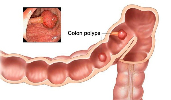 Nguyên nhân và cách phòng tránh ung thư đại trực tràng