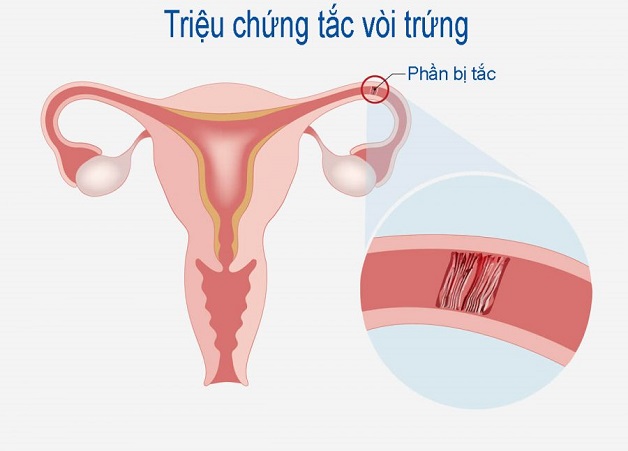 Nguyên nhân và dấu hiệu nhận biết mang thai ngoài tử cung