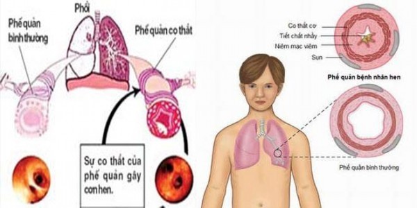 Nguyên nhân và triệu chứng bệnh hen phế quản