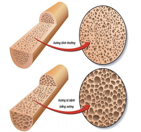 Nguyên nhân và triệu chứng bệnh loãng xương