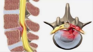 Nguyên nhân và triệu chứng bệnh thoát vị đĩa đệm