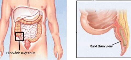 Nguyên nhân và triệu chứng bệnh viêm ruột thừa