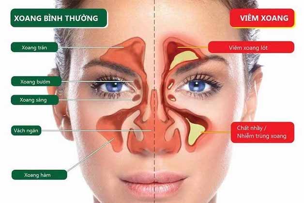 Nguyên nhân và triệu chứng của viêm xoang mũi là gì?