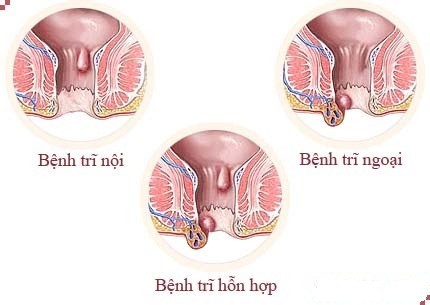 Nguyên nhân và triệu chứng mắc bệnh trĩ