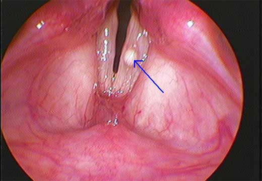 Nguyên nhân và triệu chứng polyp dây thanh quản