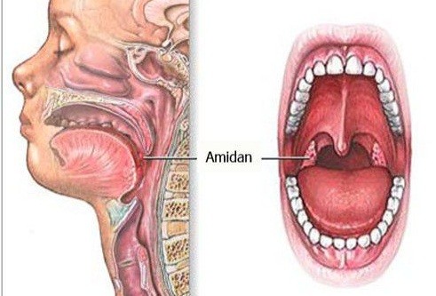 Nguyên nhân viêm amidan với virus, vi khuẩn gây bệnh