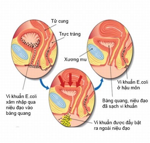 Nguyên nhân viêm đường tiết niệu là gì?