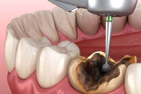 Nguyên tắc điều trị tủy răng số 7