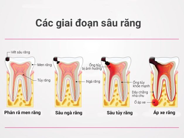 Nha sĩ mách bạn cách chữa sâu răng triệt để