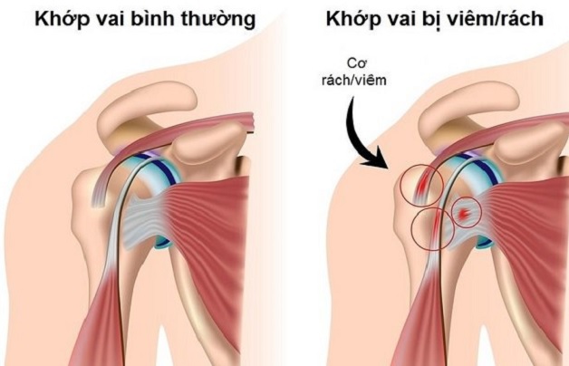 Nhận biết bệnh viêm chu vai và cách điều trị