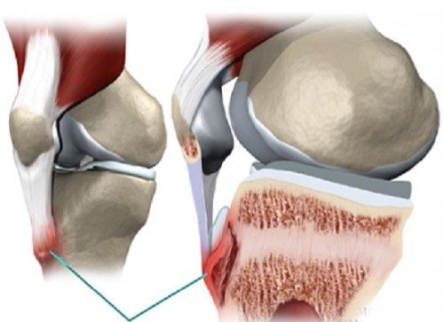 Nhận biết bệnh viêm gân cổ tay, chân và đầu gối