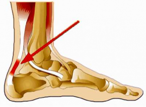 Nhận biết bệnh viêm gân cổ tay, chân và đầu gối