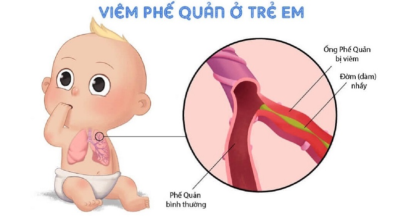 Nhận biết biểu hiện bệnh viêm phế quản, phân biệt với viêm họng