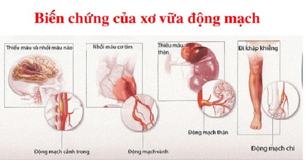 Nhận biết các dấu hiệu của tai biến mạch máu não 