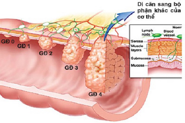 Nhận biết các dấu hiệu ung thư dạ dày giai đoạn cuối