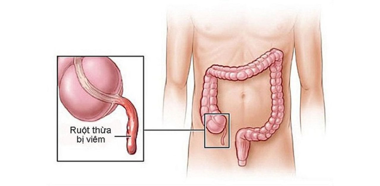 Nhận biết các triệu chứng của bệnh đau ruột thừa