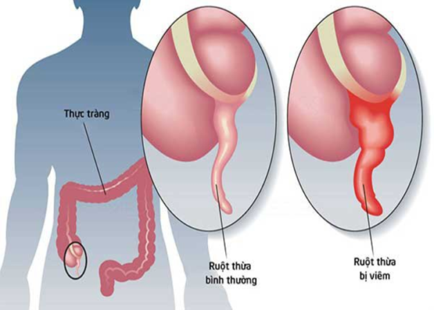 Nhận biết các triệu chứng của bệnh đau ruột thừa