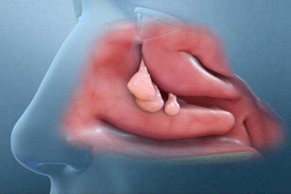 Nhận biết các triệu chứng polyp mũi