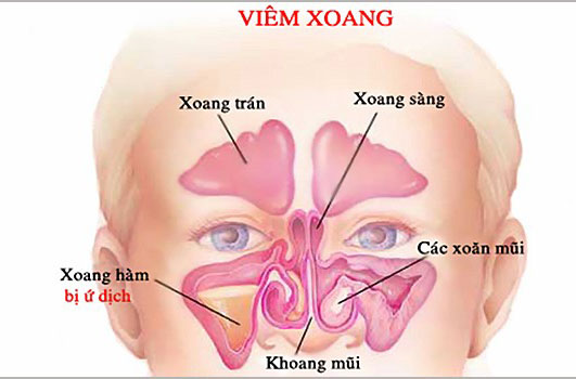 Nhận biết các triệu chứng viêm xoang ở trẻ em