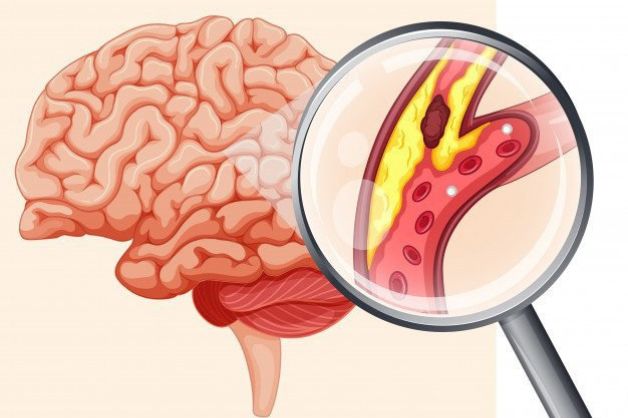 Nhận biết dấu hiệu nhồi máu não và cách phòng ngừa