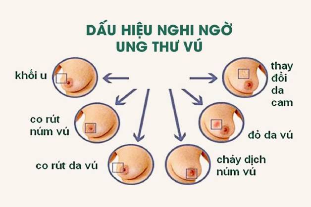 Nhận biết dấu hiệu tầm soát ung thư vú đúng lúc