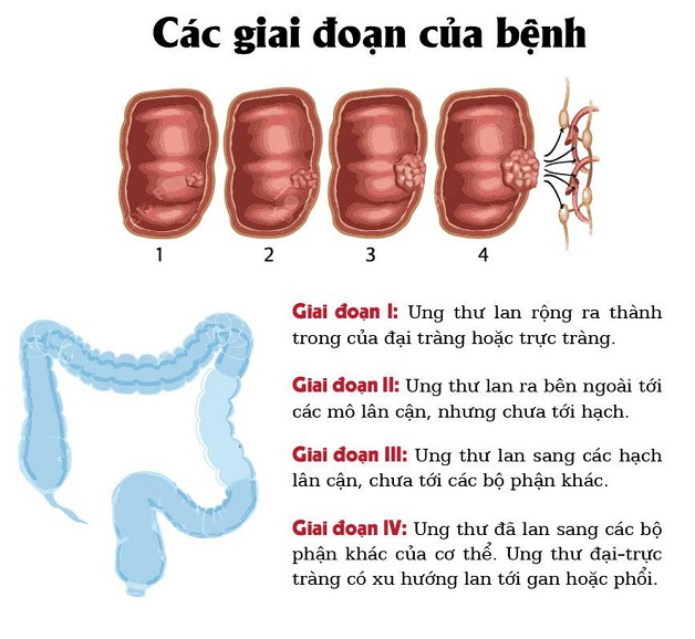 Nhận biết dấu hiệu ung thư đại tràng giai đoạn đầu