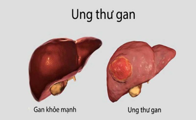 Nhận biết dấu hiệu ung thư gan qua các giai đoạn phát triển