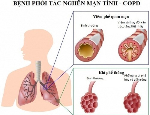 Nhận biết phổi tắc nghẽn mạn tính