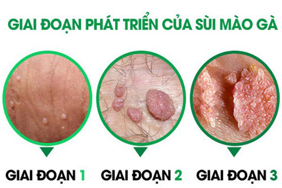 Nhận biết sớm các dấu hiệu bệnh sùi mào gà