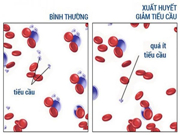 Nhận biết sớm các dấu hiệu xuất huyết giảm tiểu cầu vô căn