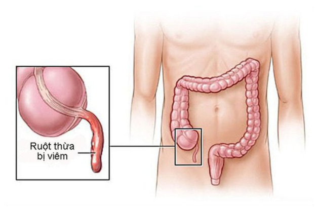 Nhận biết sớm các triệu chứng của đau ruột thừa