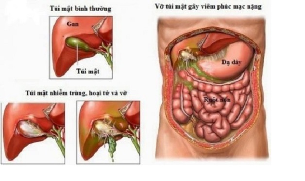 Nhận biết sớm dấu hiệu viêm ruột thừa cấp tính